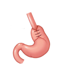 Hiatal Surgery