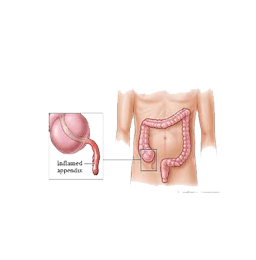 appendix surgery