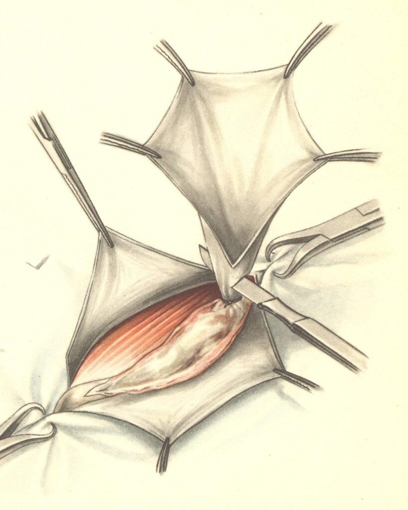 hernia surgery